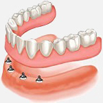 Dentex Denture Clinic Implant Dentures 1, Dentex Dental