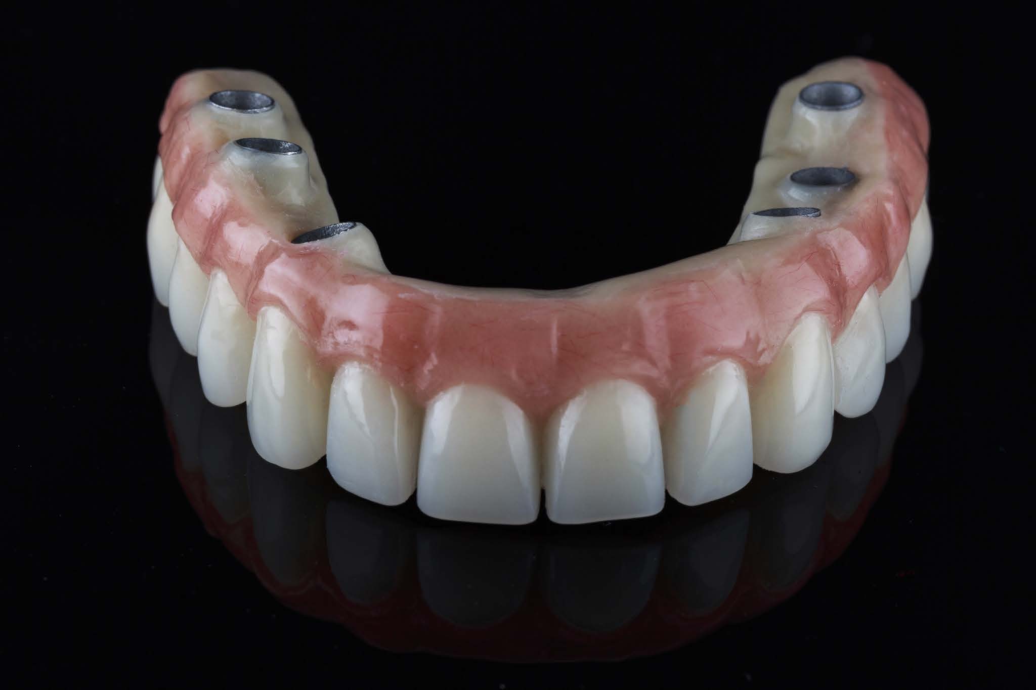 The Best Of Both Worlds: Implant-Supported Dentures