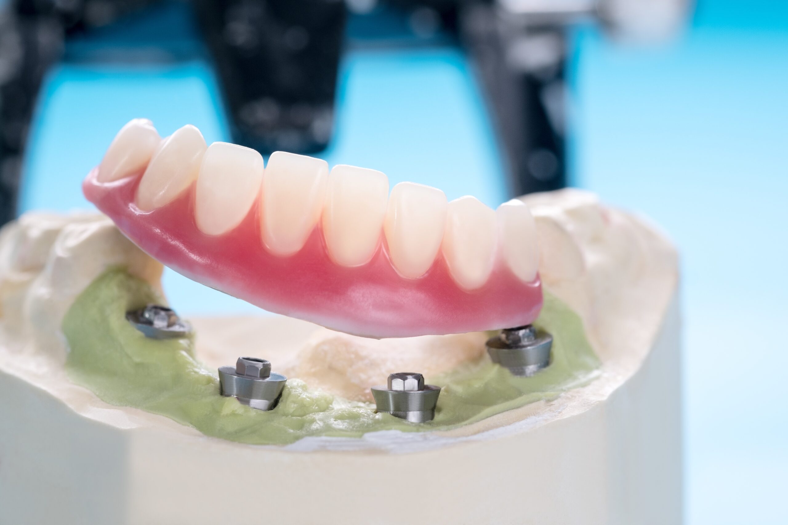 Implants In Dentures: The Best of Both In One