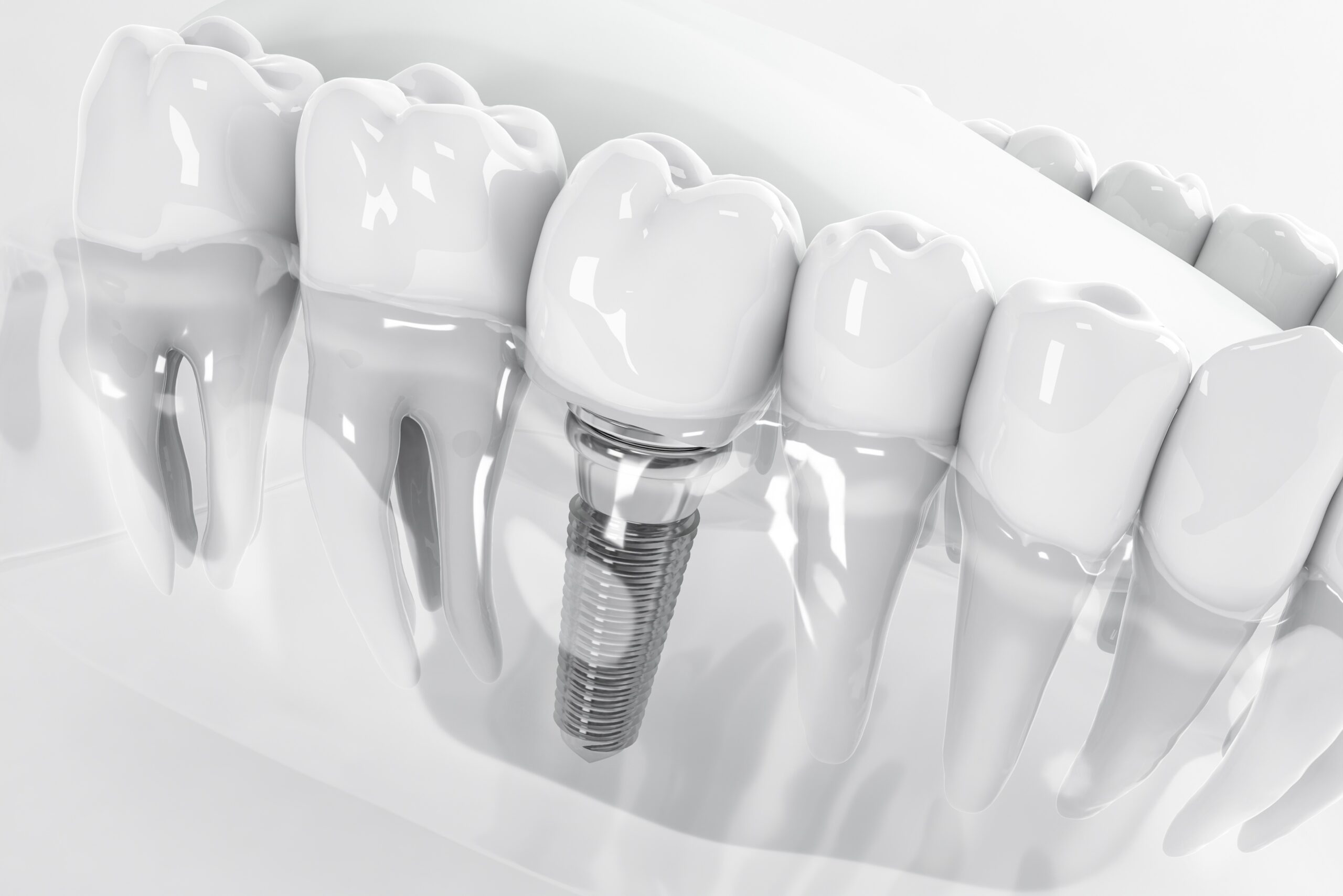 Dentures Vs Dental Implants: What’s Right For Your Teeth