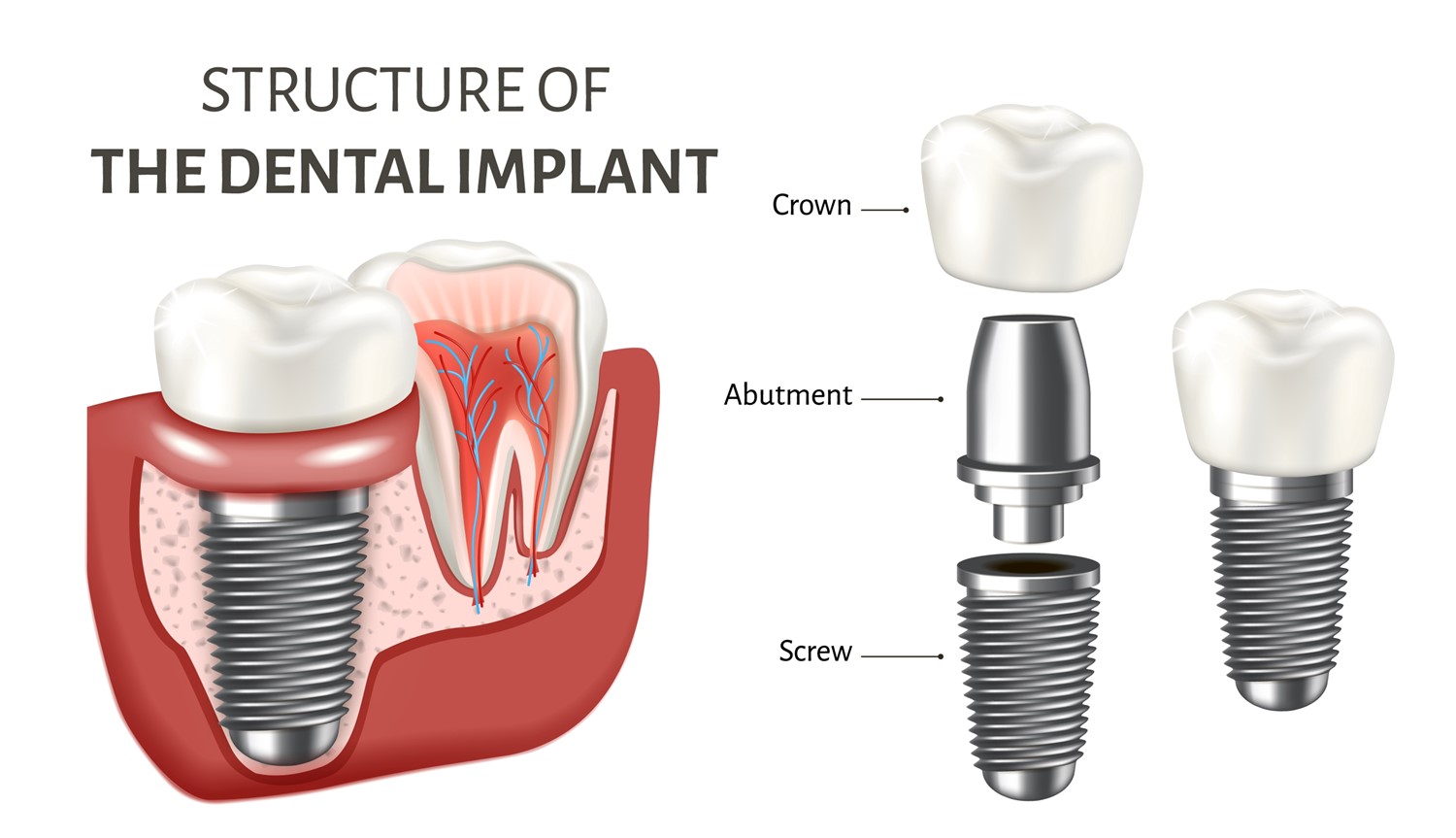 Structure Of The Dental Implant, Dentex Dental