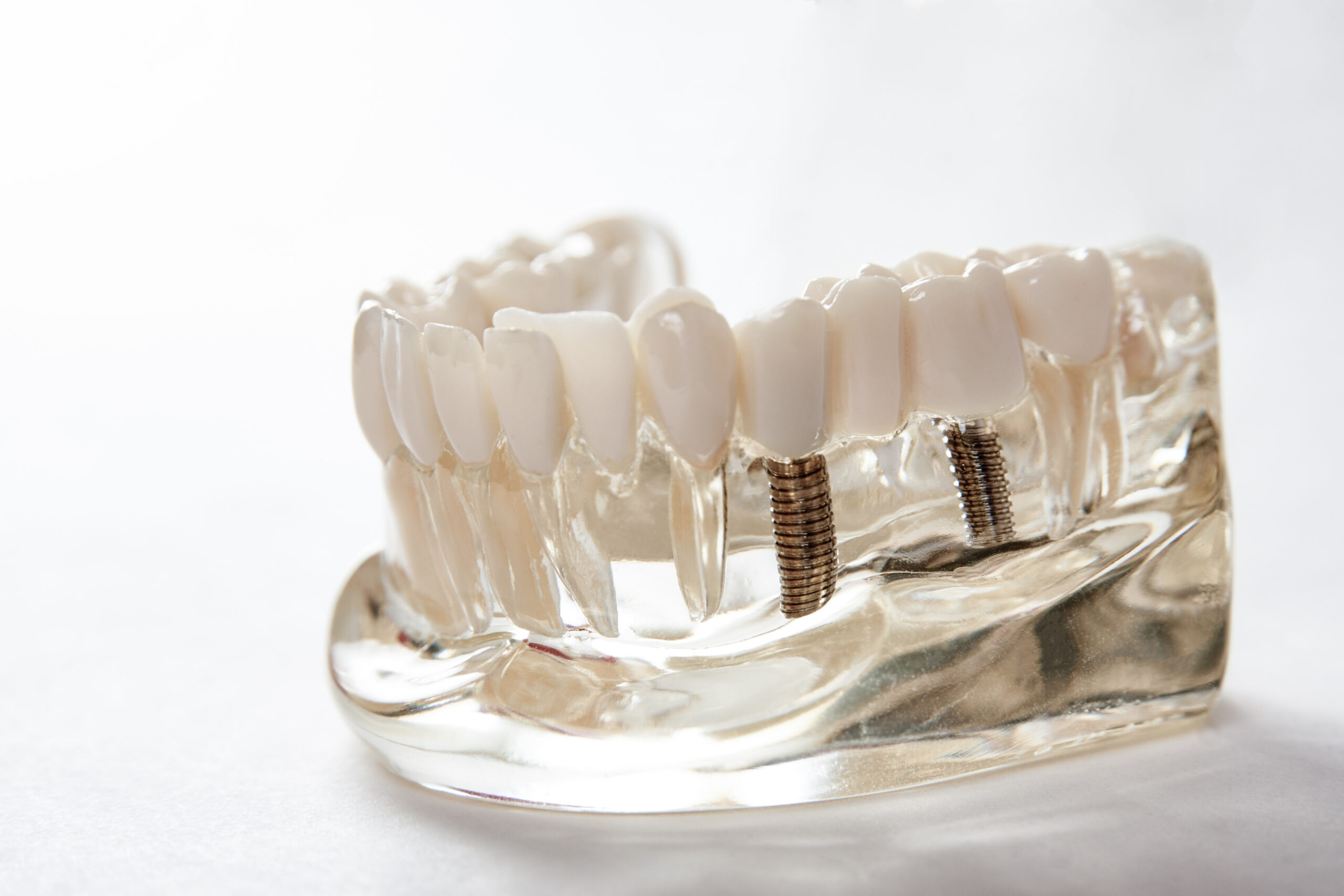 Things To Know About Switching From Dentures To Implants