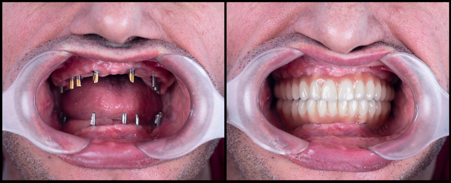 What Are Implant Retained Dentures?