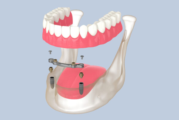 Implant Retained Dentures2 600x403, Dentex Dental