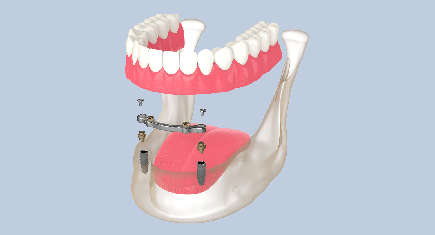 Pros And Cons Of Implant Retained Dentures